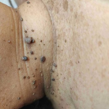 Acrocordones en la zona del cuello, antes del procedimiento de eliminación