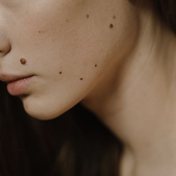 Piel del rostro con manchas, vista de perfil